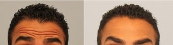 Male Botox patient 