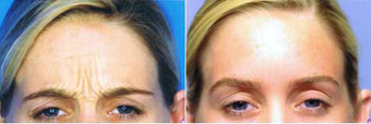 Botox
