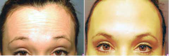 Botox