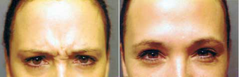 Botox