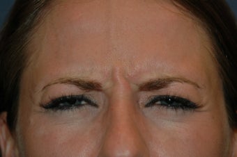 Botox injected in between the eyebrows and into the forehead