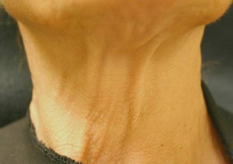 Botox Injections for Platisma Bands