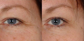 Botox