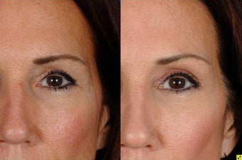 Botox