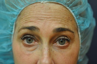 Botox