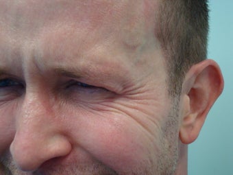 Botox- Crow's Feet