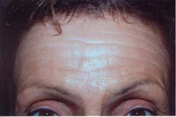 Botox