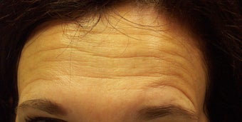 Botox Injections