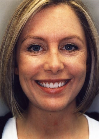 Botox