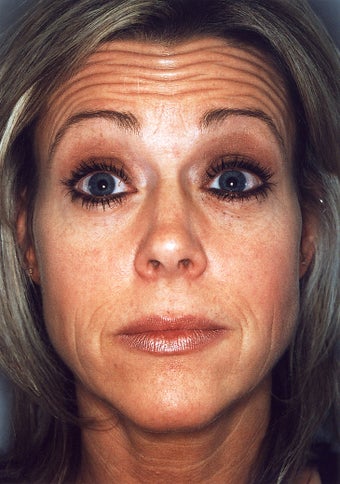 Botox