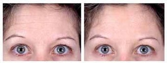 Botox for Forehead Wrinkles