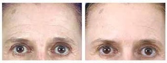 Botox and Browlift