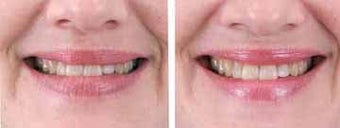 Botox for wrinkles