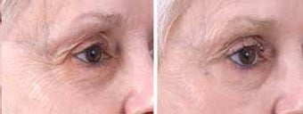 Botox for Frown Lines