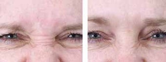 Botox for bunny lines