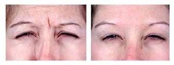 Botox for expression lines