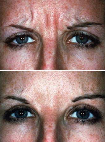  Botox showing Facial Expression Before & After
