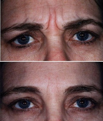  Showing Expression Before and After Botox