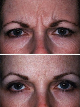  Botox Forehead Before and After
