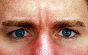 Botox Treatment of the Glabella ( 11s ) 