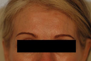 Coreecting Asymmetry with Botox (Dysport Browlift). 
