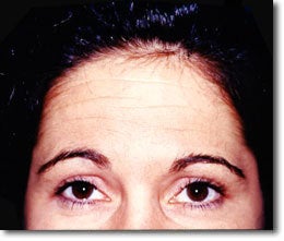 BOTOX 