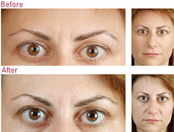 Botox between the eyes