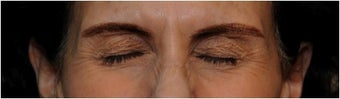 Botox
