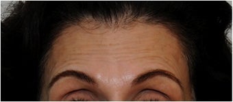 Botox