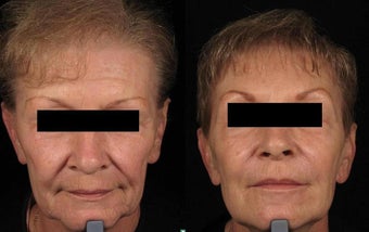Botox and Sculptra