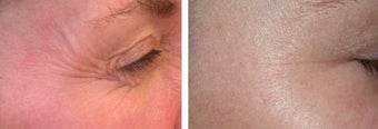 Botox