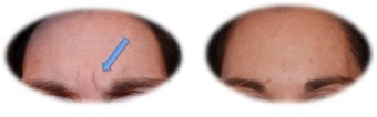 Botox