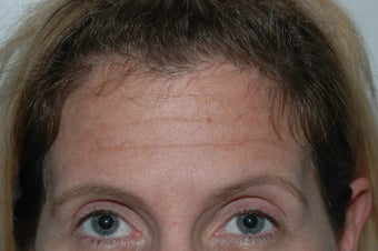 Botox