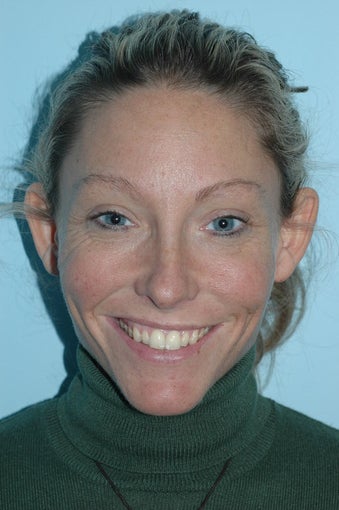 Botox Radiesse