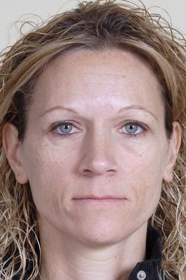 Botox and Restylane