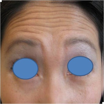 Botox