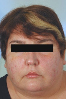 Botox and Restylane for Mouth Frown
