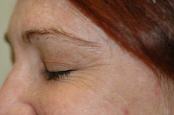 Botox for Crow's Feet