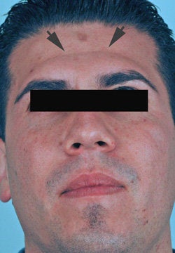 Botox treatment for forehead