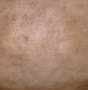 Botox for pebble chin