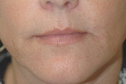 Lip enhancement (smoker's lines)
