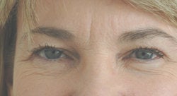 Botox forehead lines (frown lines) 