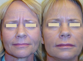 Botox and Fillers