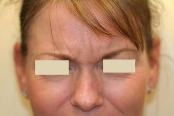 Botox