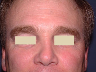 Botox