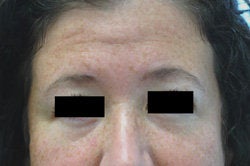 Botox for forehead lines