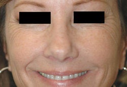 Botox for Crows Feet 
