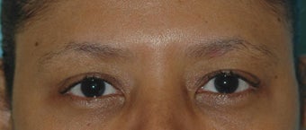 Botox Treatment