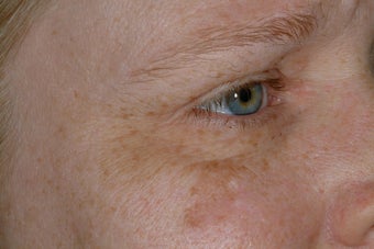 Non-surgical eye rejuvenation
