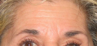 Botox Treatment for Forehead and Brow Wrinkles